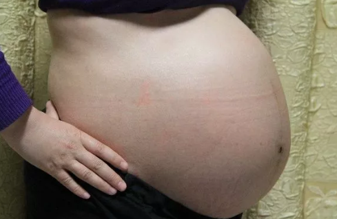 懷雙胞胎先兆子癇怎么辦 懷雙胞胎更容易先兆子癇嗎