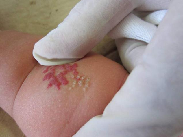 寶寶血管瘤和什么有關 嬰兒血管瘤哪些情況需要處理