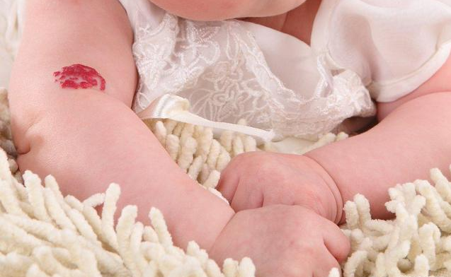 寶寶血管瘤和什么有關 嬰兒血管瘤哪些情況需要處理