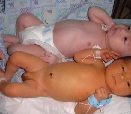 新生兒黃疸和孕婦有關系嗎 新生兒黃疸怎么辦 新生兒黃疸和孕婦有關系嗎 新生兒黃疸怎么辦