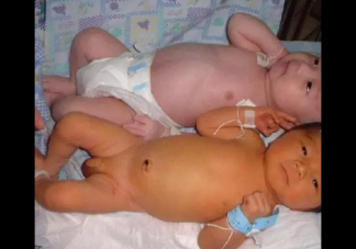 新生兒黃疸和孕婦有關系嗎 新生兒黃疸怎么辦