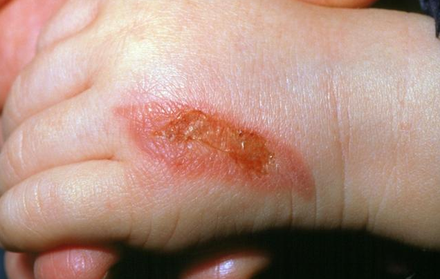 孩子燙傷抹牙膏有用嗎 孩子被燙傷處理的正確方法 孩子燙傷抹牙膏有用嗎 孩子被燙傷處理的正確方法