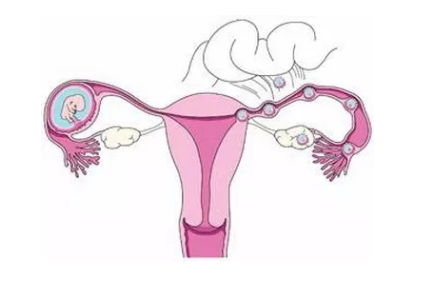 預防宮外孕的運動有哪些 跳繩能夠預防宮外孕嗎