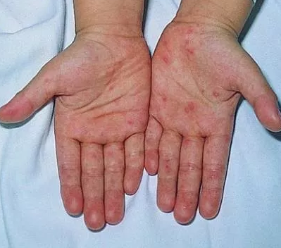 寶寶得了手足口病怎么辦 護理手足口病寶寶的方法