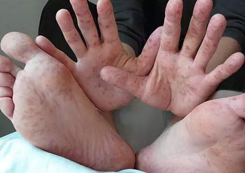 寶寶得了手足口病怎么辦 護理手足口病寶寶的方法