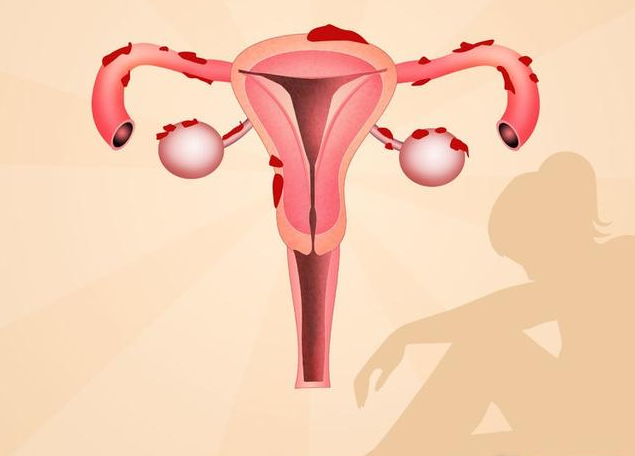 絕經后子宮肌瘤會長嗎 絕經后子宮肌瘤會不會萎縮