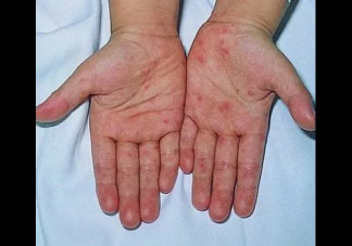 寶寶得了手足口病怎么辦 護理手足口病寶寶的方法