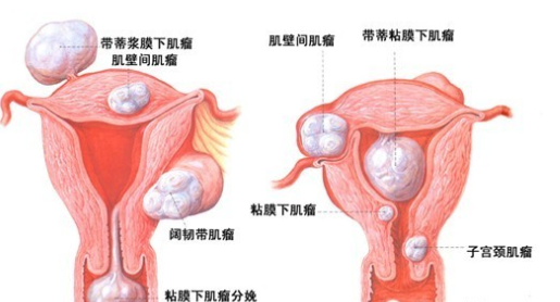 子宮肌瘤影響懷孕嗎 懷孕后發現子宮肌瘤有影響嗎