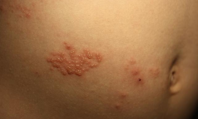 帶狀皰疹和生殖器皰疹一樣嗎 生殖器皰疹和帶狀皰疹有什么區別