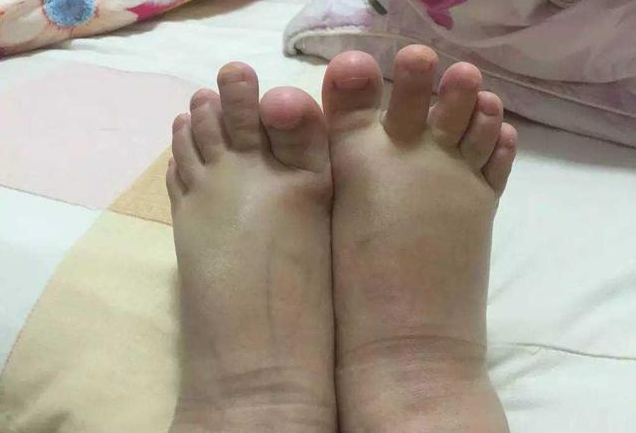 孕婦生理性水腫怎么緩解 孕期水腫什么時候恢復正常