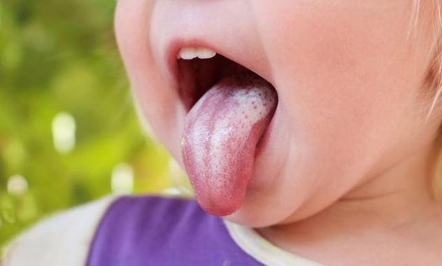 寶寶長鵝口瘡有哪些危害 寶寶長鵝口瘡的護理方法 寶寶長鵝口瘡有哪些危害 寶寶長鵝口瘡的護理方法