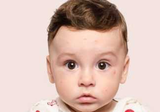 寶寶一到夏天就長痱子是怎么回事 寶寶痱子怎么護(hù)理