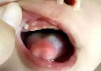 新生兒口腔需要清洗嗎 嬰兒口腔該怎么護理