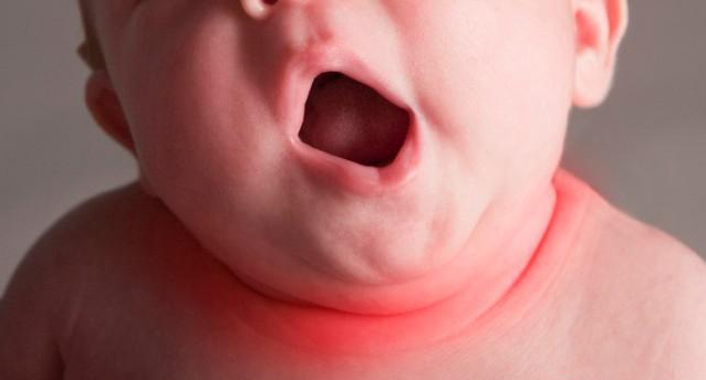 寶淹脖子發紅怎么護理 如何避免淹脖子復發