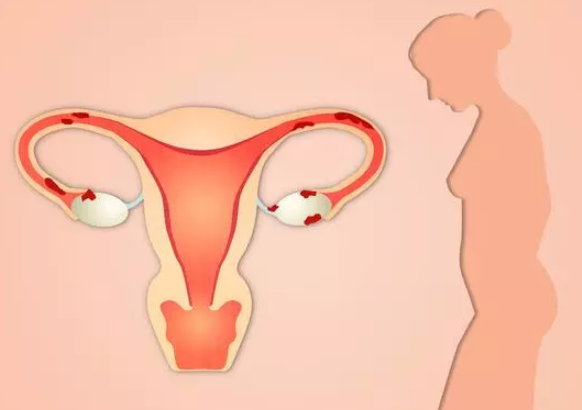 子宮內膜異位癥和遺傳有關嗎 子宮內膜異位癥能做試管嬰兒嗎