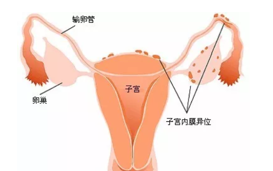 子宮內膜異位癥手術后能懷孕嗎 子宮內膜異位癥會痛經嗎
