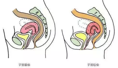 子宮前傾容易懷孕嗎 子宮前傾和后傾的區(qū)別 子宮前傾容易懷孕嗎 子宮前傾和后傾的區(qū)別
