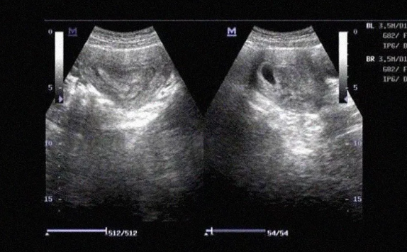 子宮縱隔一定要做手術(shù)嗎 子宮縱膈手術(shù)后注意事項(xiàng)