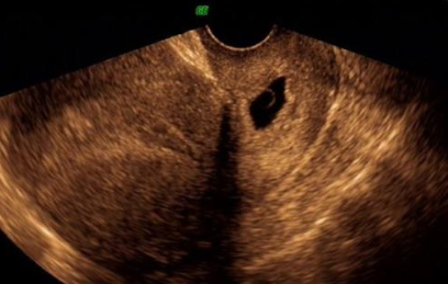 宮頸妊娠藥物怎么治療 宮頸妊娠是大手術(shù)嗎 宮頸妊娠藥物怎么治療 宮頸妊娠是大手術(shù)嗎