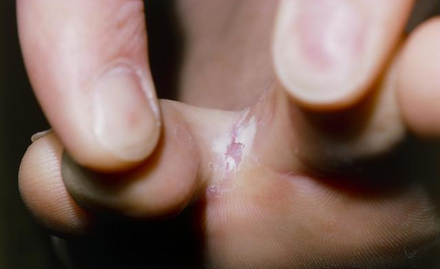 用醋泡腳可以治腳氣嗎 腳氣的不同類型及治療方法 用醋泡腳可以治腳氣嗎 腳氣的不同類型及治療方法