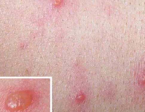 小孩得水痘的初期癥狀是什么 小孩得水痘注意事項 小孩得水痘的初期癥狀是什么 小孩得水痘注意事項