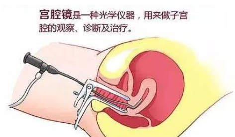宮腔鏡檢查需要住院嗎 哪些情況需要做宮腔鏡檢查