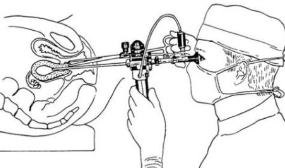 宮腔鏡檢查后注意什么 宮腔鏡檢查后有并發癥嗎 宮腔鏡檢查后注意什么 宮腔鏡檢查后有并發癥嗎