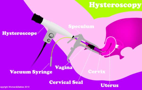 宮腔鏡檢查需要麻醉嗎 宮腔鏡檢查詳細流程