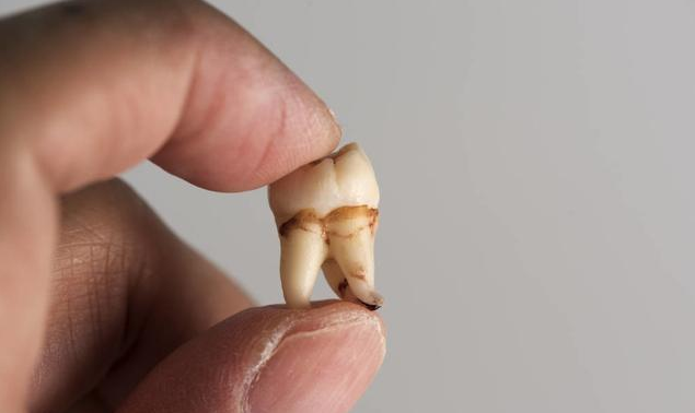 長智齒牙齦腫痛怎么辦 哪些情況是必須要拔除智齒