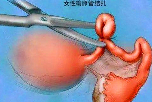 生完好孩子結扎還是上環好 結扎和上環有什么不同