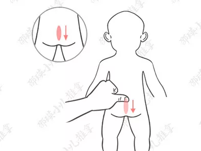 孩子小兒疳癥怎么治療 如何用推拿手法治療小兒疳癥