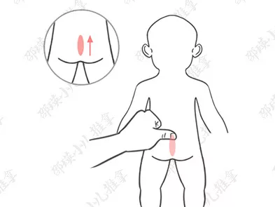 孩子小兒疳癥怎么治療 如何用推拿手法治療小兒疳癥