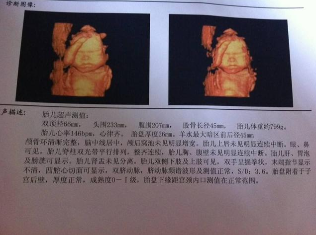 四維彩超寶寶為什么愛捂臉 四維彩超檢查應該看哪些指標