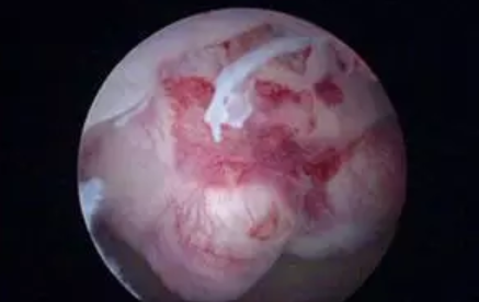 電刀手術(shù)對內(nèi)膜損傷大真的嗎 宮腔鏡電刀手術(shù)安全嗎