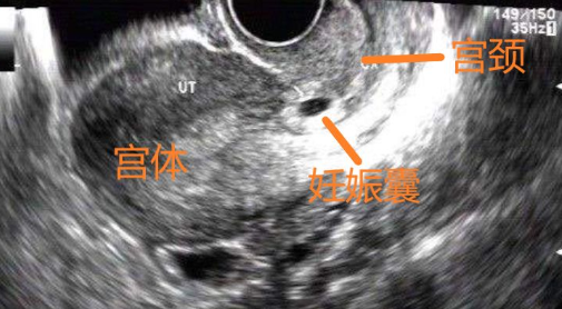 宮頸妊娠要做清宮手術嗎 宮頸妊娠要做什么治療最好