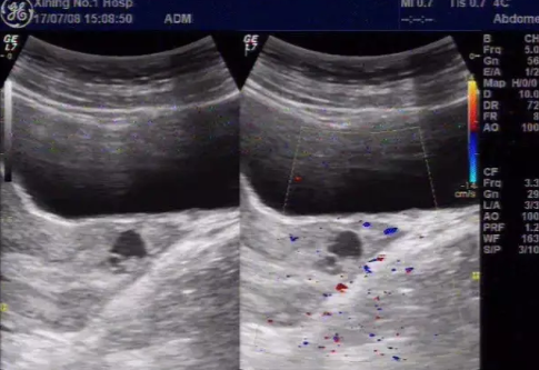 宮頸妊娠治療難度大嗎 宮頸妊娠婦科檢查癥狀