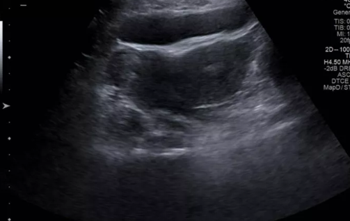 雙角子宮對懷孕有哪些影響 怎么判斷是不是雙角子宮 雙角子宮對懷孕有哪些影響 怎么判斷是不是雙角子宮