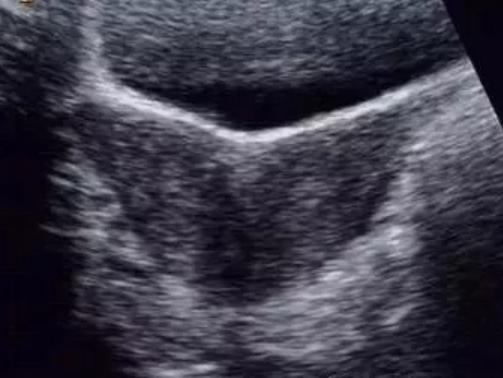 為什么會(huì)出現(xiàn)雙角子宮 雙角子宮對(duì)女性懷孕的影響有哪些 為什么會(huì)出現(xiàn)雙角子宮 雙角子宮對(duì)女性懷孕的影響有哪些