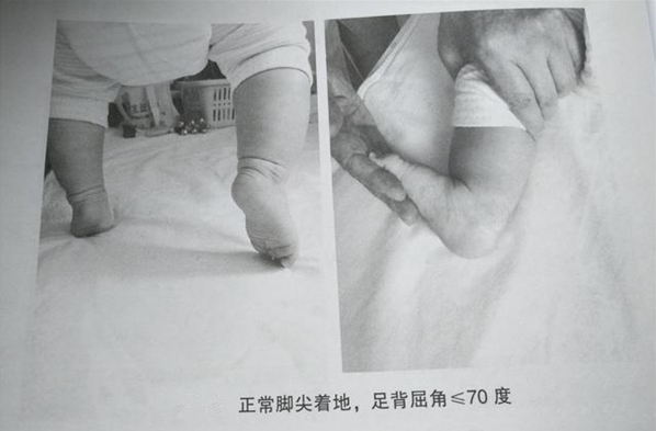 寶寶腳尖走路是腦癱嗎 如何區(qū)分足尖走路是正常還是異常