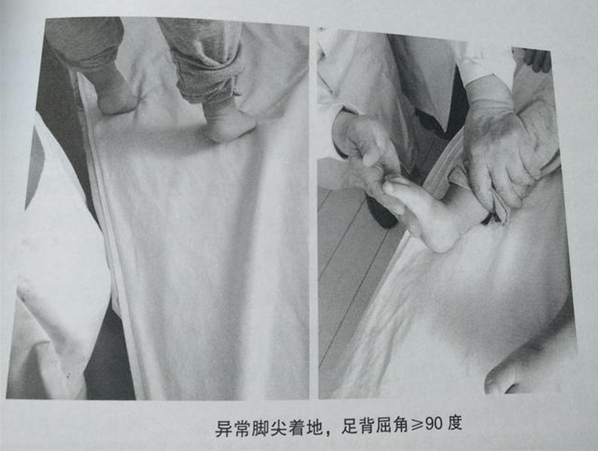 寶寶腳尖走路是腦癱嗎 如何區(qū)分足尖走路是正常還是異常