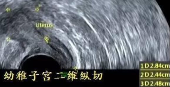 幼稚子宮可以生育嗎 幼稚子宮怎么成功備孕