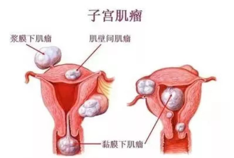 子宮偏小還能懷孕嗎 子宮偏小懷孕的幾率就小嗎
