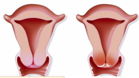 宮頸癌的高危人群有哪些 宮頸癌的治療方法