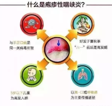 寶寶皰疹性咽峽炎治療方法 寶寶皰疹性咽峽炎需要吃藥嗎 寶寶皰疹性咽峽炎治療方法 寶寶皰疹性咽峽炎需要吃藥嗎