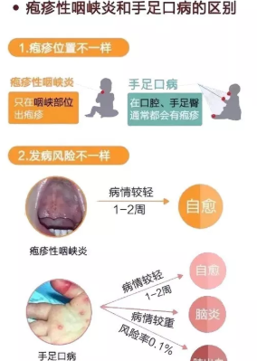 寶寶皰疹性咽峽炎治療方法 寶寶皰疹性咽峽炎需要吃藥嗎 寶寶皰疹性咽峽炎治療方法 寶寶皰疹性咽峽炎需要吃藥嗎