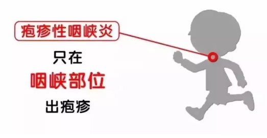 寶寶皰疹性咽峽炎和手足口病區別 如何預防小兒皰疹性咽峽炎