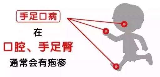 寶寶皰疹性咽峽炎和手足口病區(qū)別 如何預(yù)防小兒皰疹性咽峽炎 寶寶皰疹性咽峽炎和手足口病區(qū)別 如何預(yù)防小兒皰疹性咽峽炎