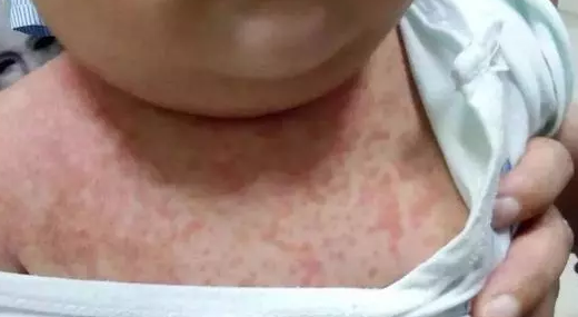 寶寶猩紅熱可以洗澡嗎 寶寶猩紅熱出疹特點