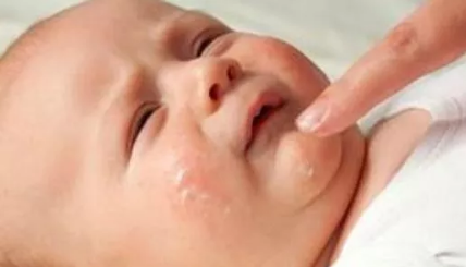 孩子濕疹反復發作什么怎么回事 如何做好濕疹預防工作