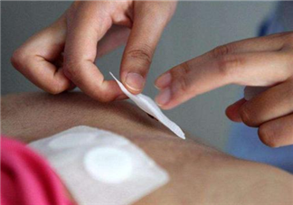 三伏貼應該怎么貼 貼三伏貼要注意什么